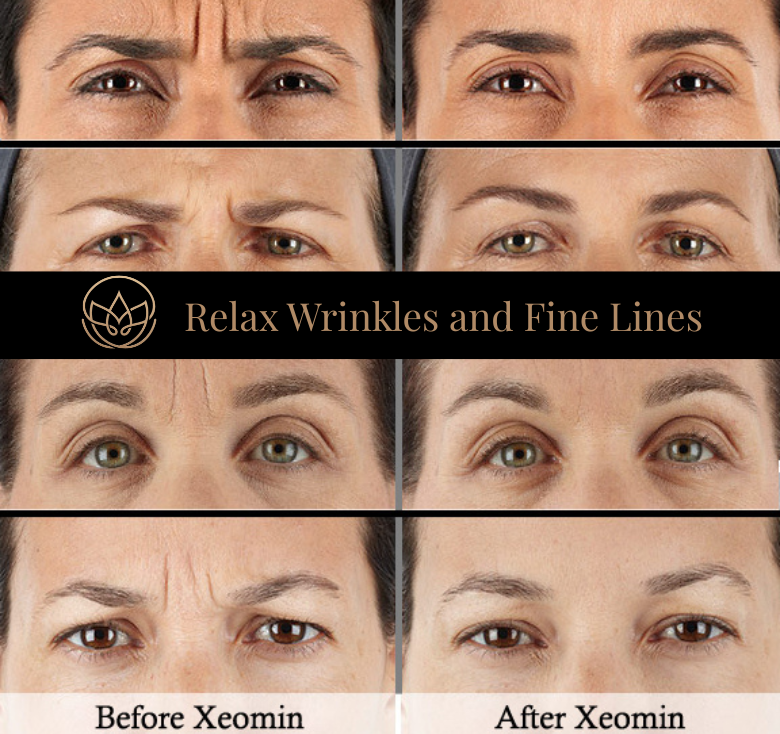 Xeomin®  Neuromodulator to help relax wrinkles and fine lines.