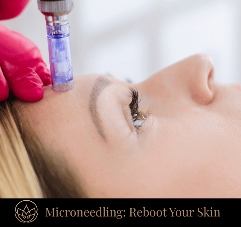 Microneedling