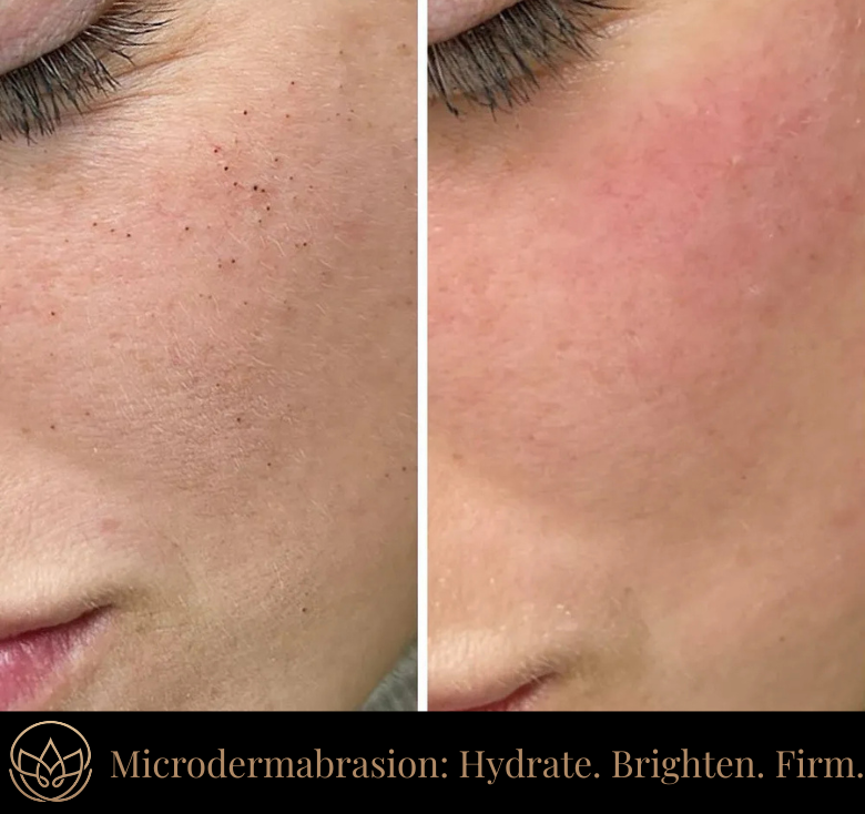 MICRODERMABRASION FACIAL